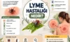 Lyme Hastalığı Nedir ve Deri Hastalığı Hakkında Bilmeniz Gerekenler Lyme Hastalığı Nedir ve Deri Hastalığı Hakkında Bilmeniz Gerekenler