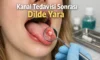 Kanal Tedavisi Sonrası Dil Yarası ve İltihabı Nedir?