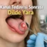 Kanal Tedavisi Sonrası Dil Yarası ve İltihabı Nedir?