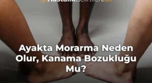 Ayakta Morarma Neden Olur, Kanama Bozukluğu Mu?