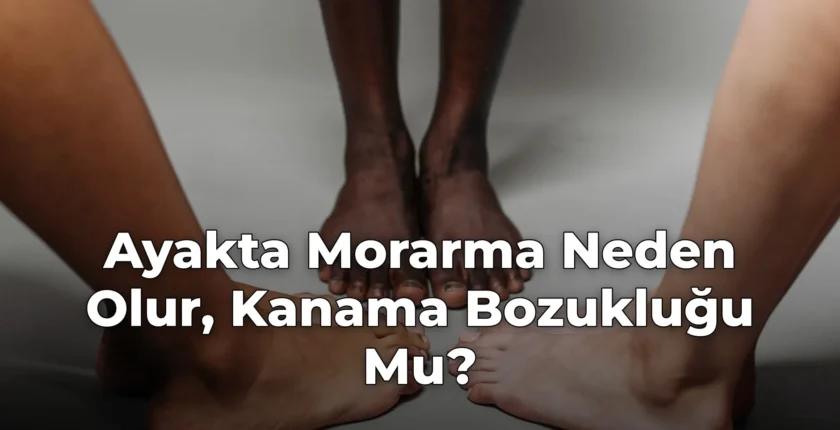 Ayakta Morarma Neden Olur, Kanama Bozukluğu Mu?