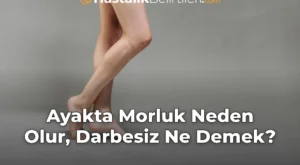 Ayakta Morluk Neden Olur, Darbesiz Ne Demek?
