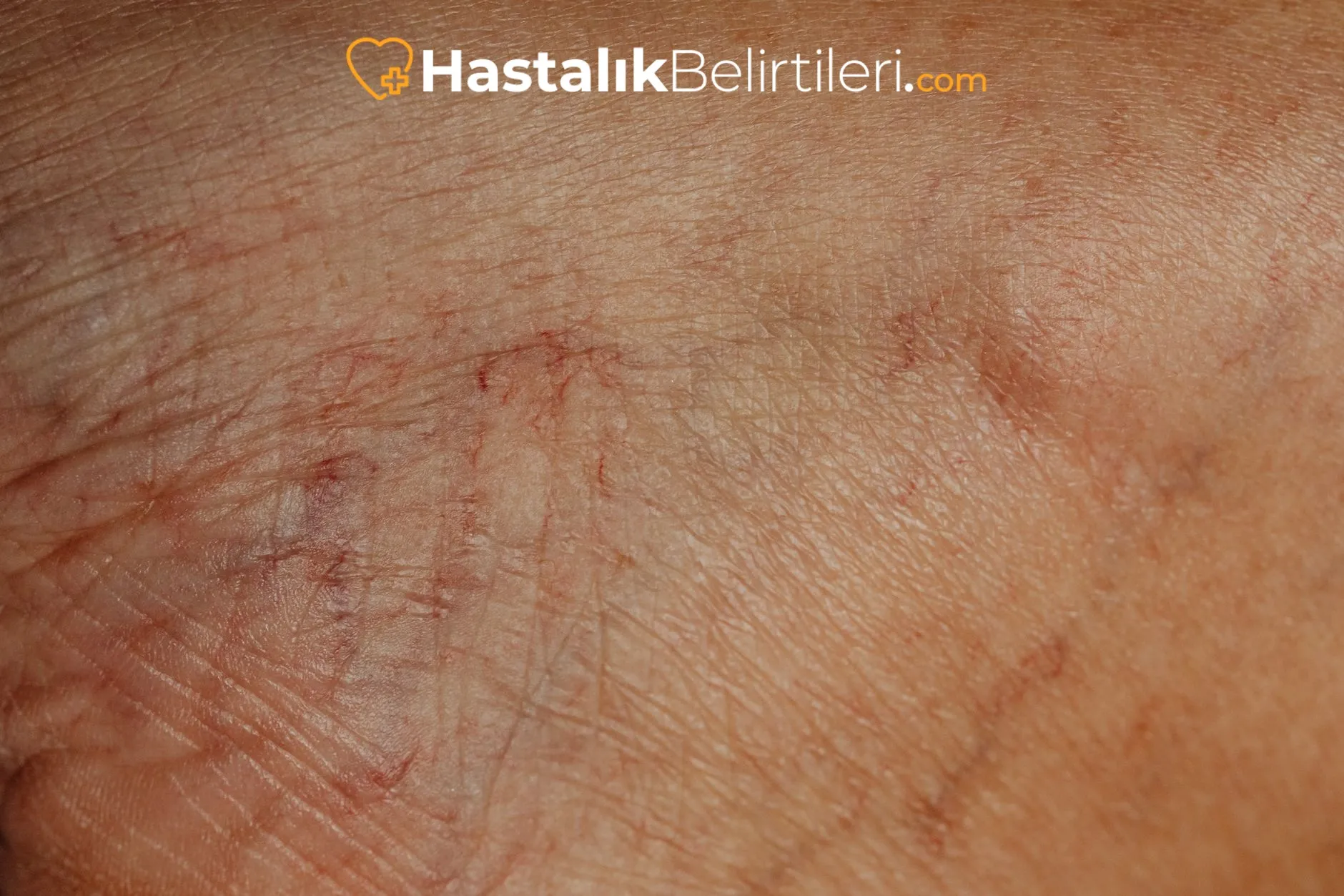 Varis ve kılcal damarlar üzerine uzman doktor muayenesi