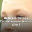 Bebeklerde Göz Çapaklanması Neden Olur?