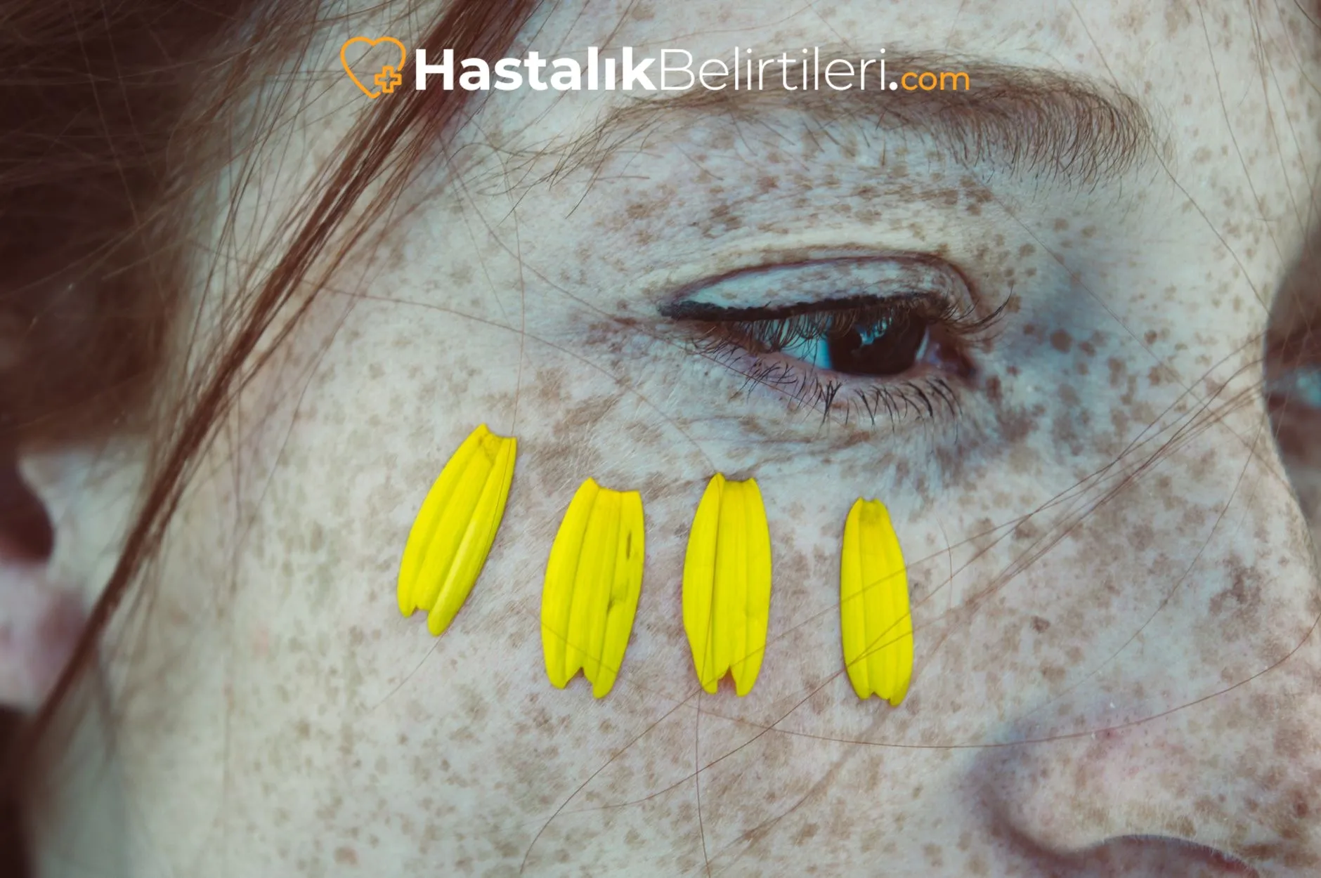 Ciltte Kaşıntı Neden Olur, Alerji Dışında? 4 ciltte kaşıntı neden olur? alerji dışında olası nedenler