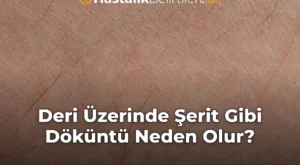Deri Üzerinde Şerit Gibi Döküntü Neden Olur?