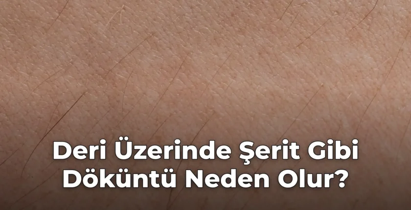 Deri Üzerinde Şerit Gibi Döküntü Neden Olur?