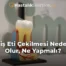 Diş Eti Çekilmesi Neden Olur, Ne Yapmalı?