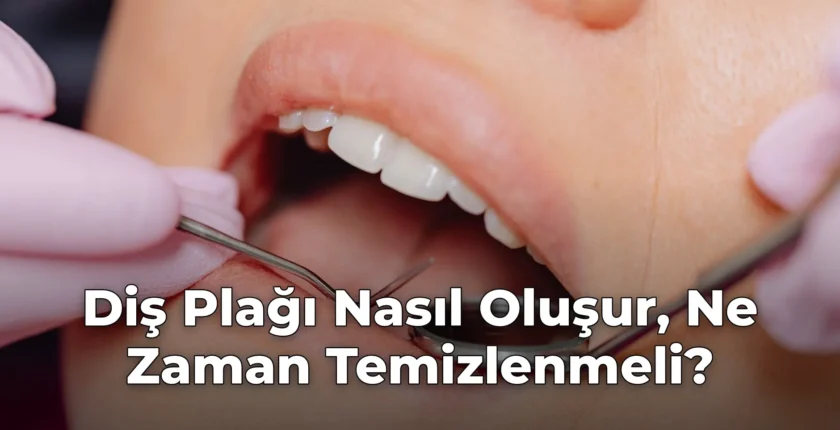 Diş Plağı Nasıl Oluşur, Ne Zaman Temizlenmeli?