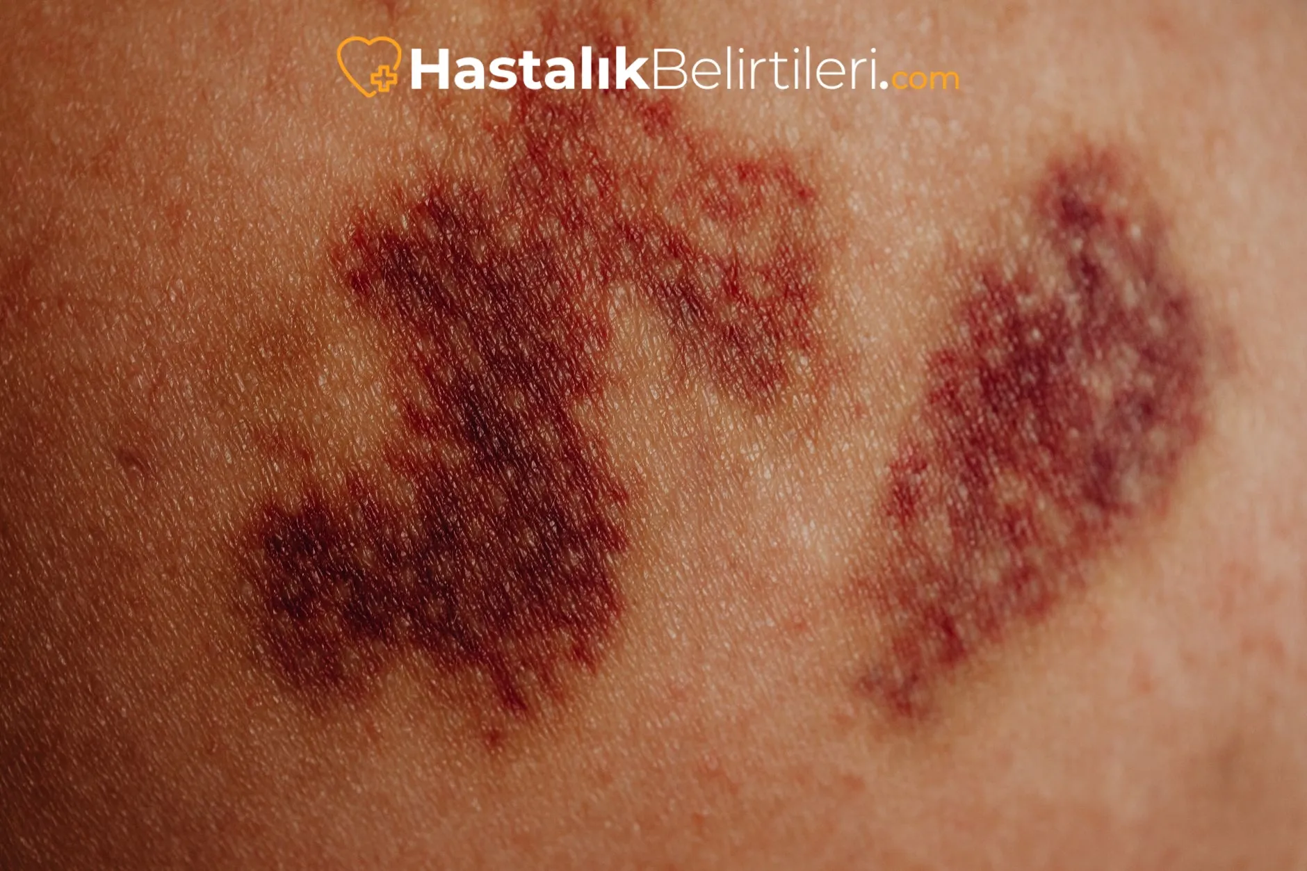 Damar kaynaklı diz dışı bacak ağrısı şüphesi