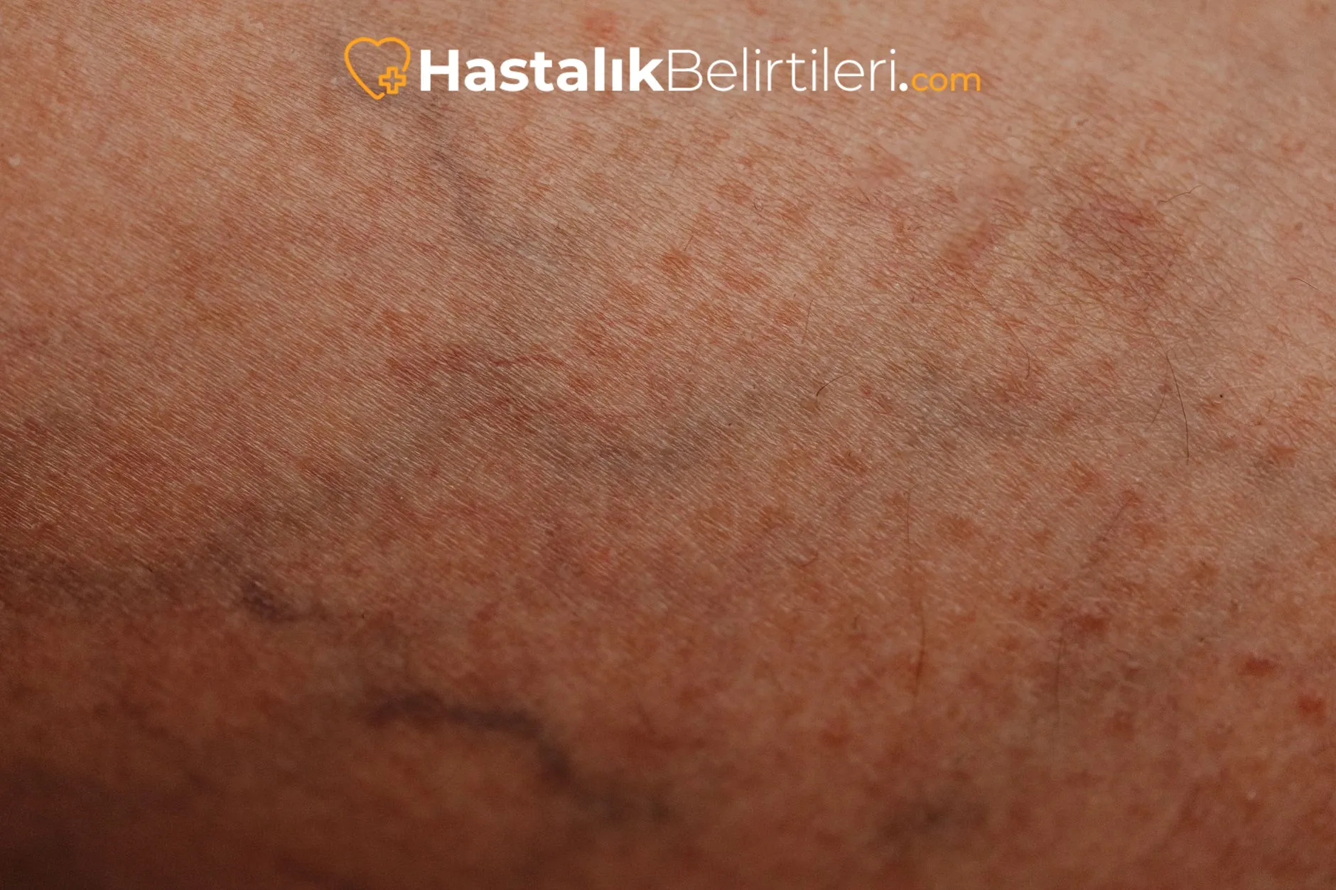 Bacakta kısmi şişlik ve ağrı: acil değerlendirme