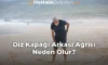 Diz Kapağı Arkası Ağrısı Neden Olur?