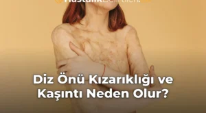 Diz Önü Kızarıklığı ve Kaşıntı Neden Olur?