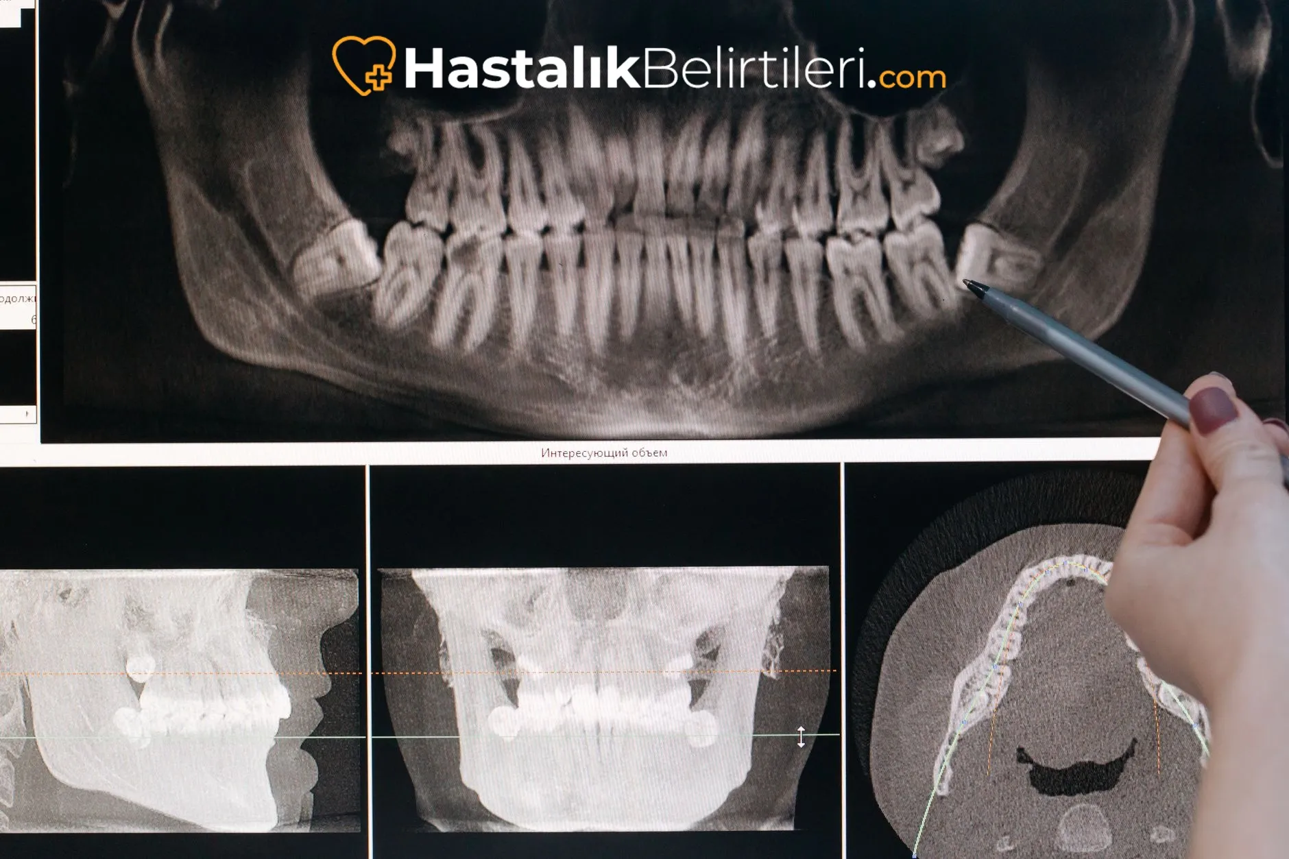 Çene eklemi yakın planı, kayma ve sıkışma belirtileri