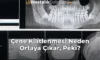 Çene Kilitlenmesi Neden Ortaya Çıkar, Peki?
