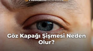 Göz Kapağı Şişmesi Neden Olur?