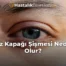 Göz Kapağı Şişmesi Neden Olur?