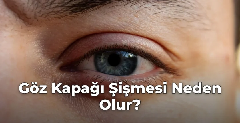 Göz Kapağı Şişmesi Neden Olur?