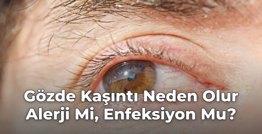 Gözde Kaşıntı Neden Olur Alerji Mi, Enfeksiyon Mu?
