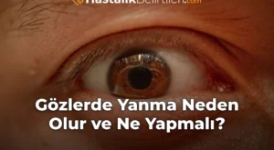 Gözlerde Yanma Neden Olur ve Ne Yapmalı?