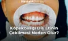 Köpekbalığı Diş Etinin Çekilmesi Neden Olur?