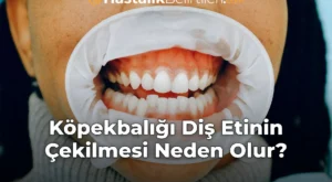 Köpekbalığı Diş Etinin Çekilmesi Neden Olur? Köpekbalığı Diş Etinin Çekilmesi Neden Olur?