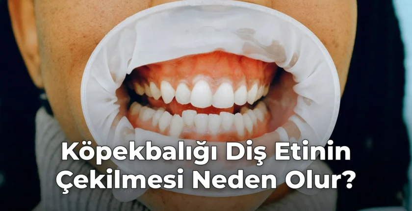Köpekbalığı Diş Etinin Çekilmesi Neden Olur?