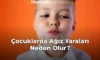 Çocuklarda Ağız Yaraları Neden Olur?