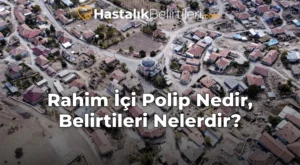 Rahim İçi Polip Nedir, Belirtileri Nelerdir?