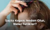 Saçta Kepek Neden Olur, Neler Tetikler?