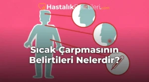 Sıcak Çarpmasının Belirtileri Nelerdir?