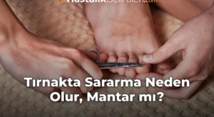 Tırnakta Sararma Neden Olur, Mantar mı?