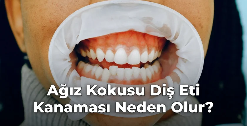 Ağız Kokusu Diş Eti Kanaması Neden Olur? Ağız Kokusu Diş Eti Kanaması Neden Olur?