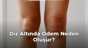 Diz Altında Ödem Neden Oluşur?