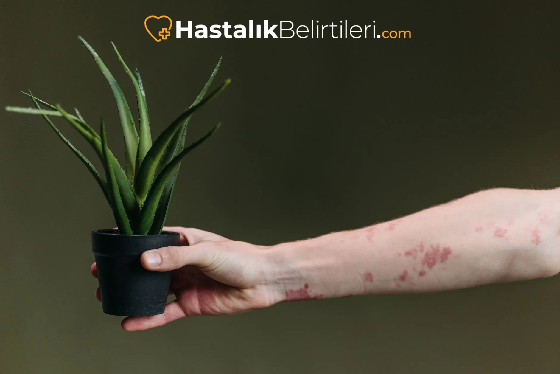 Egzama Alevlenmesini Tetikleyen Faktörler Nelerdir? 2 Tahriş edici deterjan kullanımı sonrası egzama alevlenmesi