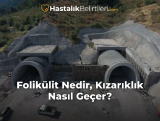Folikülit Nedir, Kızarıklık Nasıl Geçer?