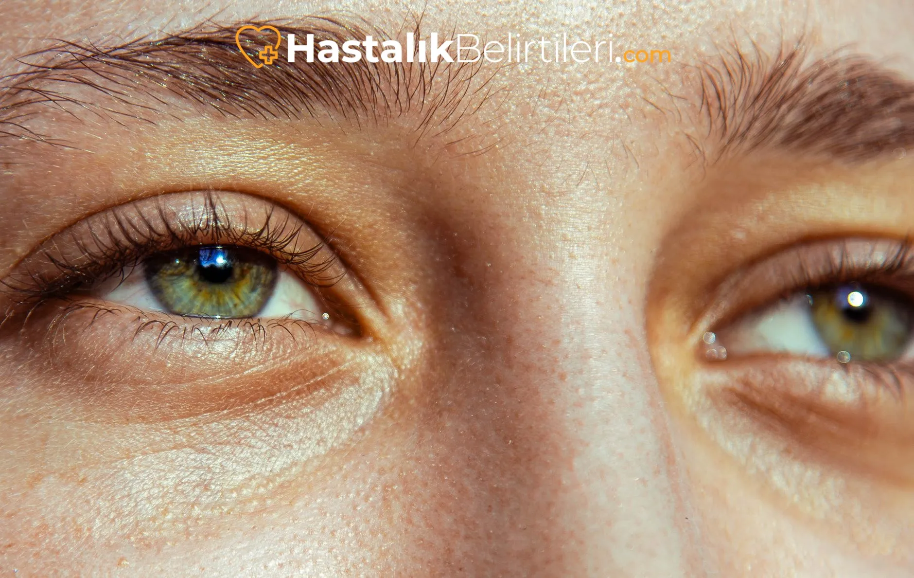 Gece Artan Kaşıntı, En Sık Nedenler 4 Böcek ısırığı şüphesiyle şişlik ve kaşıntılı lezyonlar