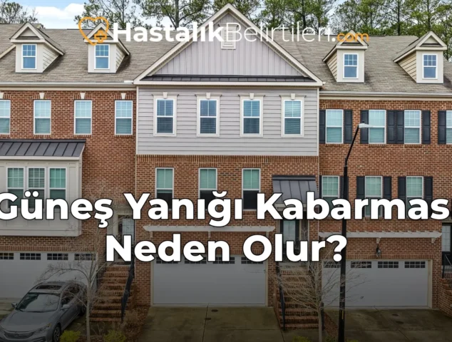 Güneş Yanığı Kabarması Neden Olur?