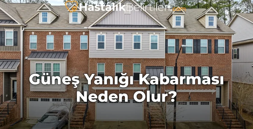 Güneş Yanığı Kabarması Neden Olur?