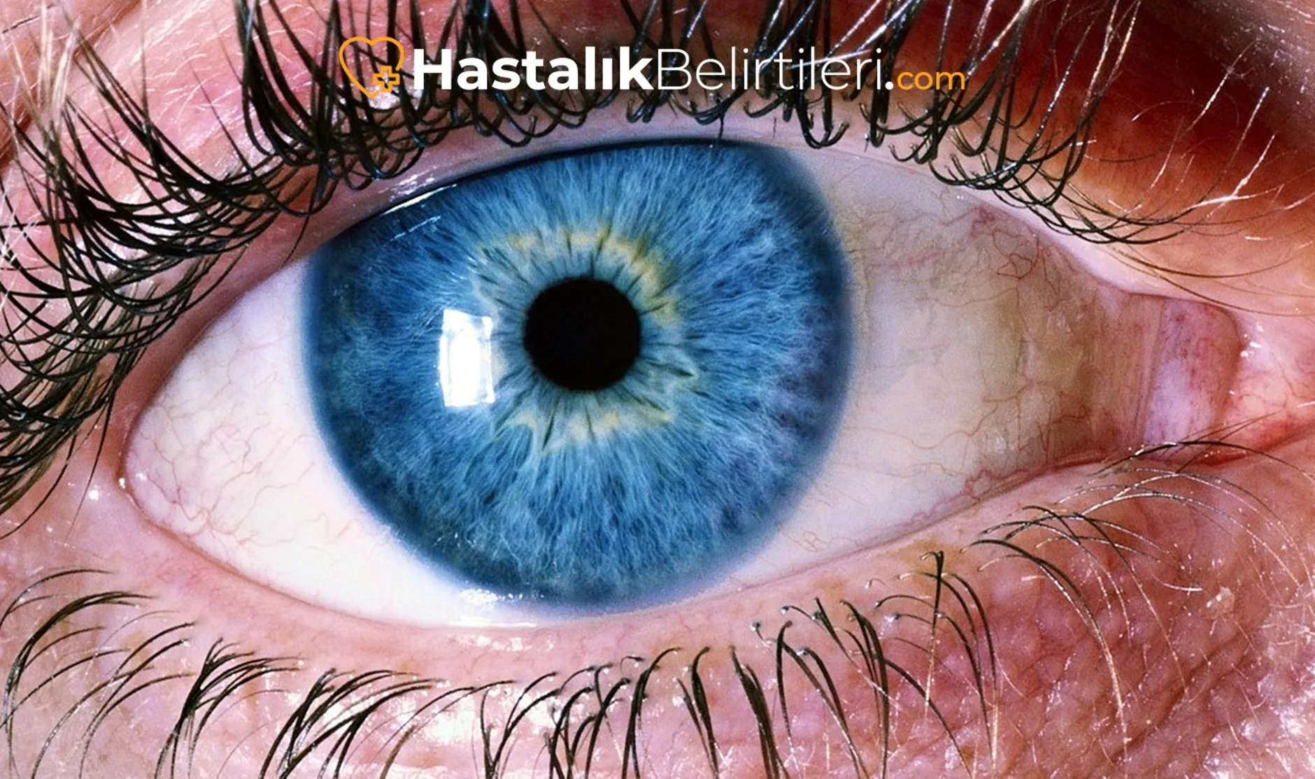 Gözde Kuruluk Neden Olur, Ne Zaman Doktora? 4 Kontakt lens kullanımında göz kuruluğu ve tahriş