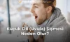 Küçük Dil (Uvula) Şişmesi Neden Olur? Küçük Dil (Uvula) Şişmesi Neden Olur?