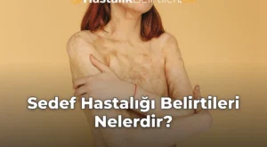 Sedef Hastalığı Belirtileri Nelerdir?