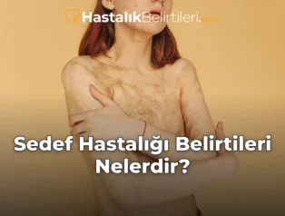 Sedef Hastalığı Belirtileri Nelerdir?