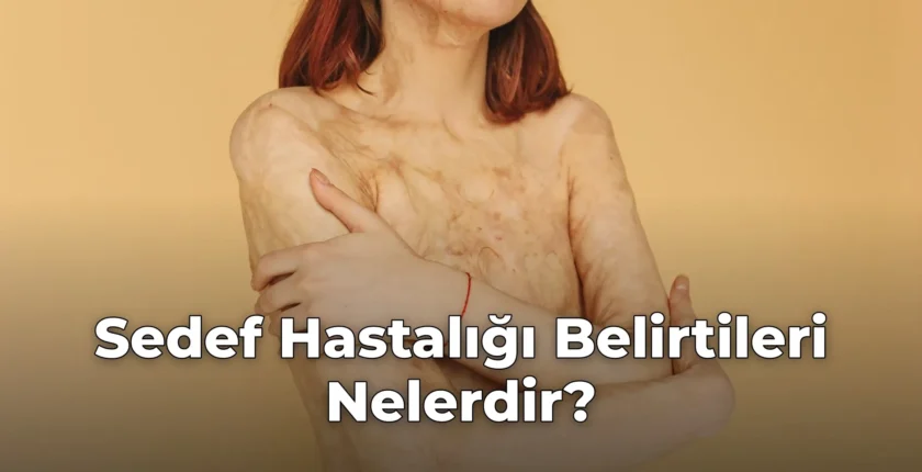 Sedef Hastalığı Belirtileri Nelerdir?